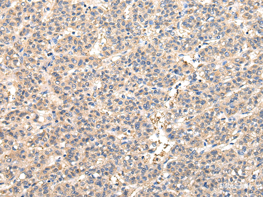 Immunohistochemistry of paraffin-embedded Human liver cancer tissue using VPS45 Polyclonal Antibody at dilution 1:50