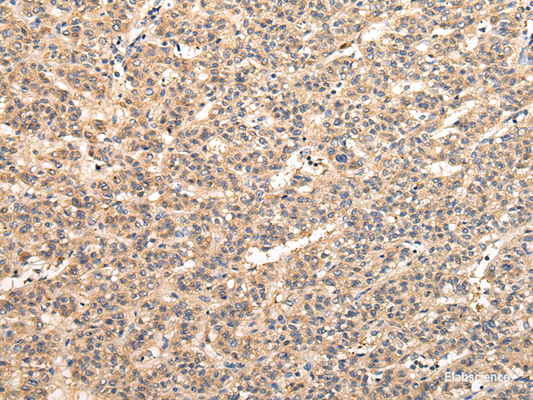Immunohistochemistry of paraffin-embedded Human liver cancer tissue using VPS33B Polyclonal Antibody at dilution 1:40