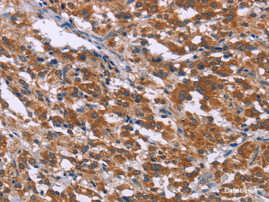 Immunohistochemistry of paraffin-embedded Human thyroid cancer tissue using SKI Polyclonal Antibody at dilution 1:40