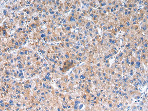 Immunohistochemistry of paraffin-embedded Human liver cancer using GLRA1 Polyclonal Antibody at dilution of  1/20