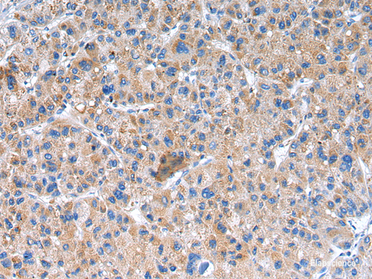 Immunohistochemistry of paraffin-embedded Human liver cancer using GLRA1 Polyclonal Antibody at dilution of  1/20