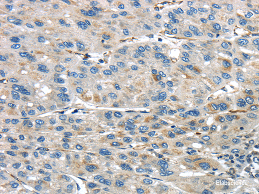 Immunohistochemistry of paraffin-embedded Human liver cancer using IQGAP2 Polyclonal Antibody at dilution of  1/45