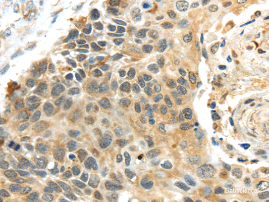 Immunohistochemistry of paraffin-embedded Human esophagus cancer using PROX1 Polyclonal Antibody at dilution of  1/40