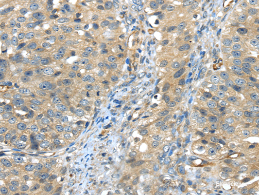 Immunohistochemistry of paraffin-embedded Human breast cancer using ISM2 Polyclonal Antibody at dilution of  1/45