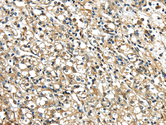 Immunohistochemistry of paraffin-embedded Human prostate cancer using NME2 Polyclonal Antibody at dilution of  1/40