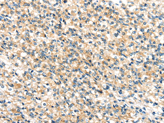 Immunohistochemistry of paraffin-embedded Human prostate cancer tissue using TTI1 Polyclonal Antibody at dilution 1:40