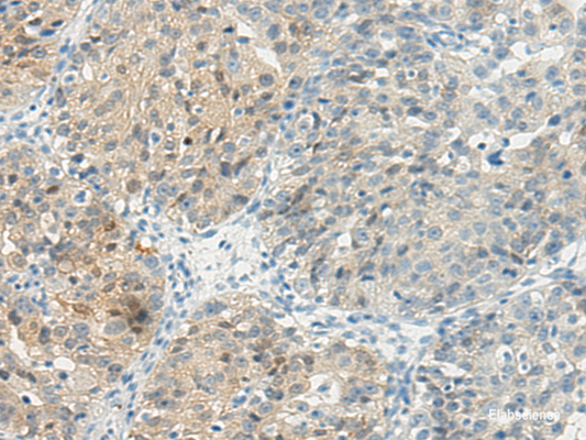 Immunohistochemistry of paraffin-embedded Human breast cancer tissue using TBXA2R Polyclonal Antibody at dilution 1:45