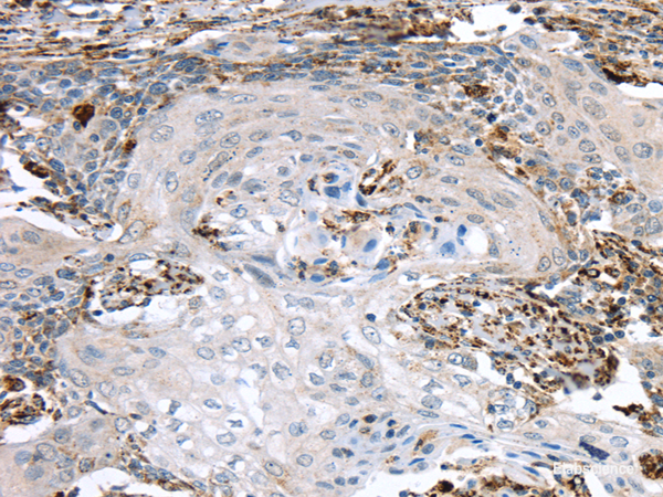 Immunohistochemistry of paraffin-embedded Human cervical cancer using TBXA2R Polyclonal Antibody at dilution of  1/40