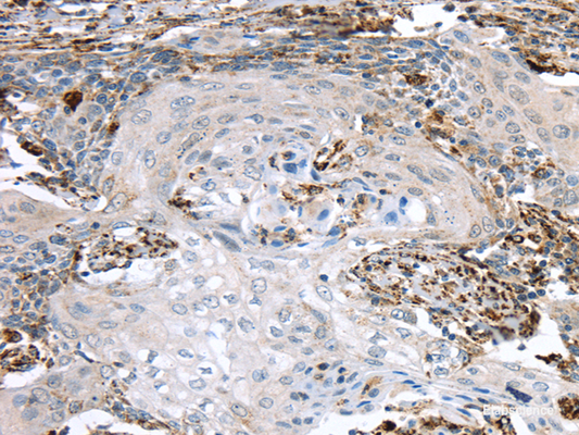 Immunohistochemistry of paraffin-embedded Human cervical cancer using TBXA2R Polyclonal Antibody at dilution of  1/40
