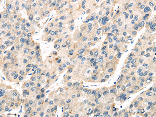 Immunohistochemistry of paraffin-embedded Human liver cancer tissue using TXNIP Polyclonal Antibody at dilution 1:50