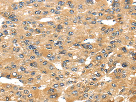 Immunohistochemistry of paraffin-embedded Human liver cancer tissue using UCP1 Polyclonal Antibody at dilution 1:40