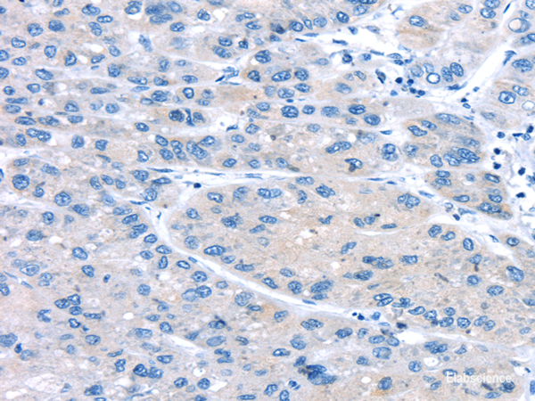Immunohistochemistry of paraffin-embedded Human liver cancer using UCP2 Polyclonal Antibody at dilution of  1/20