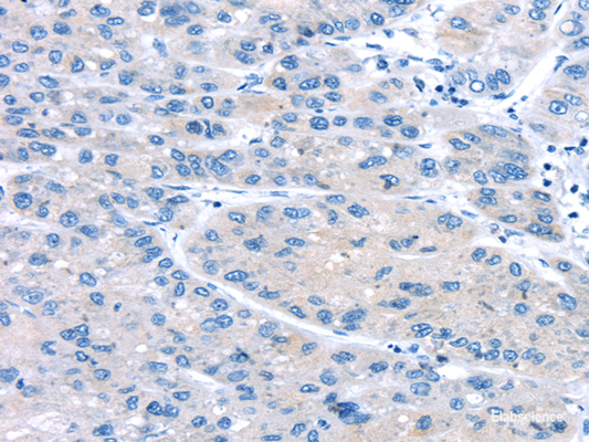 Immunohistochemistry of paraffin-embedded Human liver cancer using UCP2 Polyclonal Antibody at dilution of  1/20
