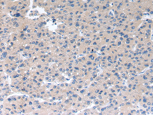 Immunohistochemistry of paraffin-embedded Human liver cancer using RAB2A Polyclonal Antibody at dilution of  1/40