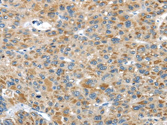 Immunohistochemistry of paraffin-embedded Human liver cancer tissue using USP9X Polyclonal Antibody at dilution 1:40