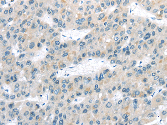Immunohistochemistry of paraffin-embedded Human liver cancer tissue using VLDLR Polyclonal Antibody at dilution 1:40