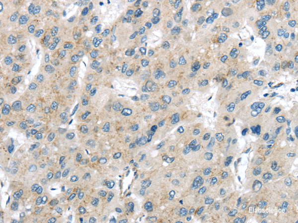 Immunohistochemistry of paraffin-embedded Human liver cancer using VPS26A Polyclonal Antibody at dilution of  1/40