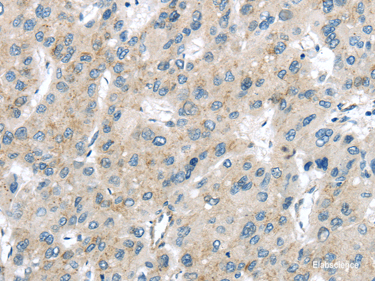 Immunohistochemistry of paraffin-embedded Human liver cancer using VPS26A Polyclonal Antibody at dilution of  1/40