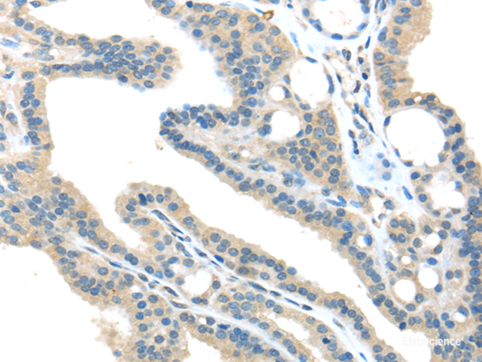 Immunohistochemistry of paraffin-embedded Human thyroid cancer tissue using VPS36 Polyclonal Antibody at dilution 1:40