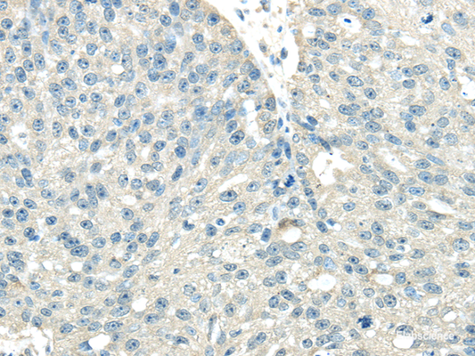 Immunohistochemistry of paraffin-embedded Human breast cancer tissue using VPS36 Polyclonal Antibody at dilution 1:40