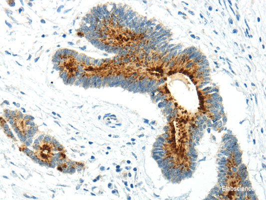 Immunohistochemistry of paraffin-embedded Human colorectal cancer using WWOX Polyclonal Antibody at dilution of  1/20