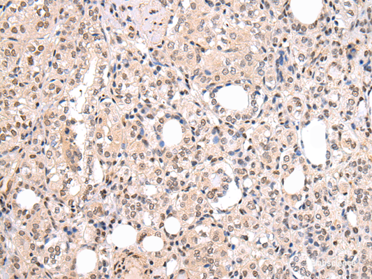 Immunohistochemistry of paraffin-embedded Human thyroid cancer using CBX7 Polyclonal Antibody at dilution of  1/20
