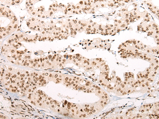 Immunohistochemistry of paraffin-embedded Human liver cancer tissue  using VPS51 Polyclonal Antibody at dilution of 1:65(×200)