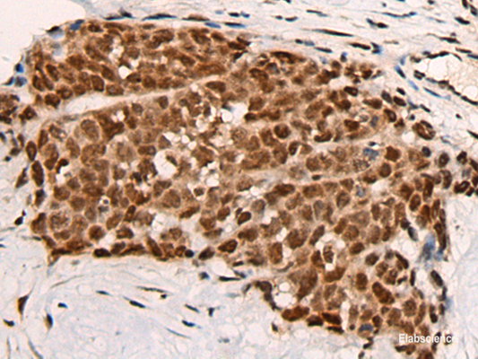 Immunohistochemistry of paraffin-embedded Human thyroid cancer tissue  using HGH1 Polyclonal Antibody at dilution of 1:45(×200)