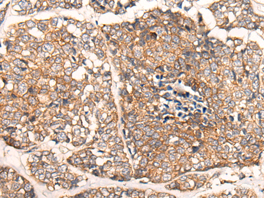 Immunohistochemistry of paraffin-embedded Human esophagus cancer tissue  using CACNA2D2 Polyclonal Antibody at dilution of 1:45(×200)