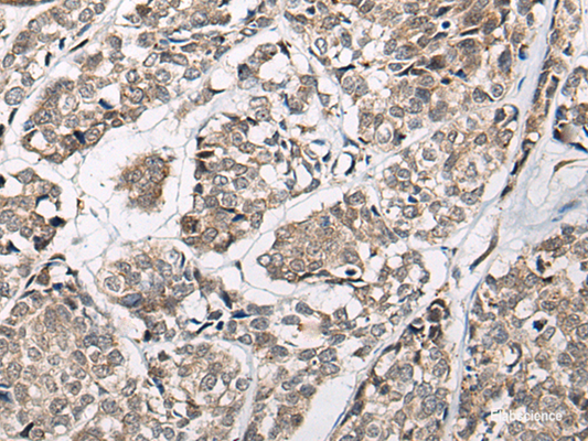 Immunohistochemistry of paraffin-embedded Human esophagus cancer tissue  using CACNB3 Polyclonal Antibody at dilution of 1:55(×200)