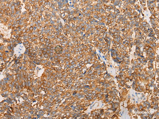 Immunohistochemistry of paraffin-embedded Human lung cancer tissue  using LRRC16A Polyclonal Antibody at dilution of 1:40(×200)