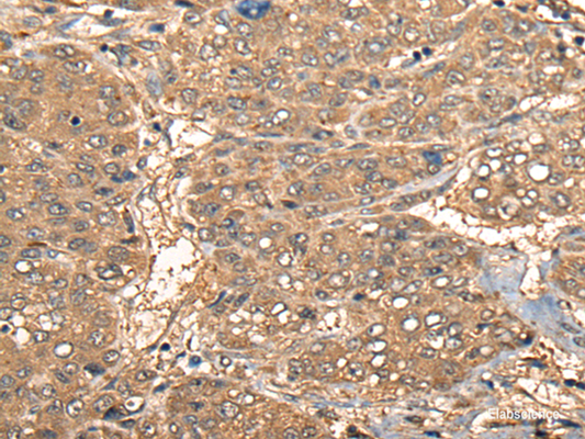 Immunohistochemistry of paraffin-embedded Human liver cancer tissue  using CCL27 Polyclonal Antibody at dilution of 1:55(×200)