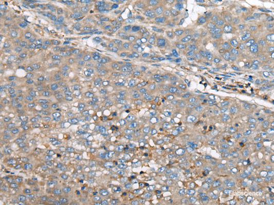 Immunohistochemistry of paraffin-embedded Human liver cancer tissue  using GULP1 Polyclonal Antibody at dilution of 1:65(×200)
