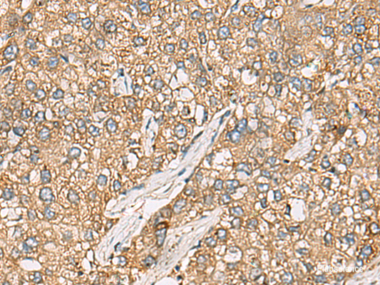 Immunohistochemistry of paraffin-embedded Human liver cancer tissue  using CHKA Polyclonal Antibody at dilution of 1:35(×200)