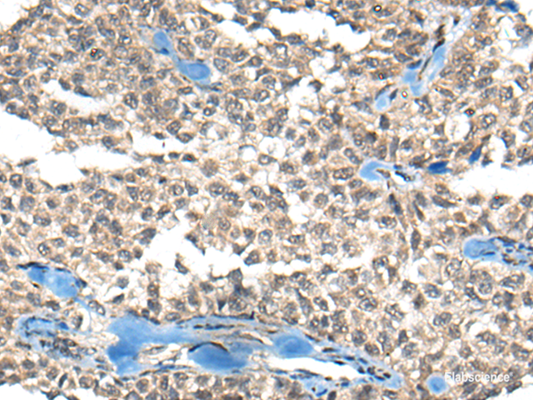 Immunohistochemistry of paraffin-embedded Human ovarian cancer tissue  using REST Polyclonal Antibody at dilution of 1:50(×200)