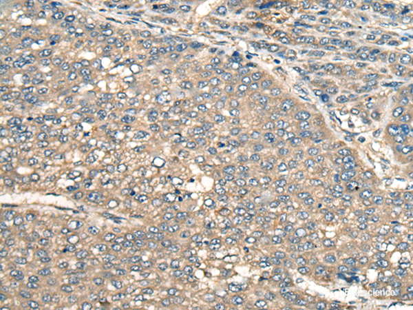 Immunohistochemistry of paraffin-embedded Human liver cancer tissue  using PIAS3 Polyclonal Antibody at dilution of 1:55(×200)