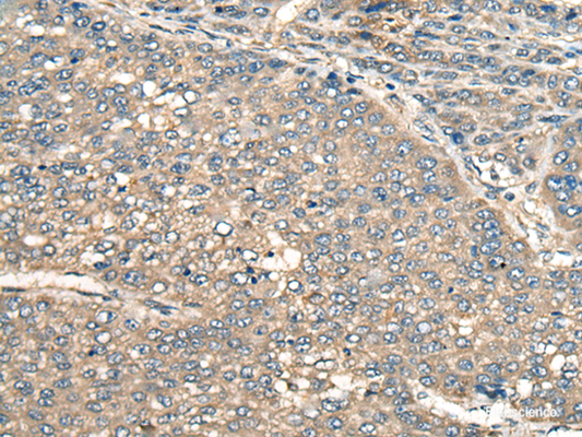 Immunohistochemistry of paraffin-embedded Human liver cancer tissue  using PIAS3 Polyclonal Antibody at dilution of 1:55(×200)