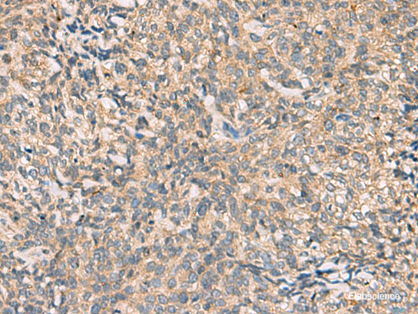 Immunohistochemistry of paraffin-embedded Human cervical cancer tissue  using CMTM4 Polyclonal Antibody at dilution of 1:55(×200)