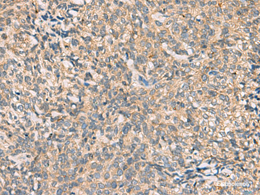 Immunohistochemistry of paraffin-embedded Human cervical cancer tissue  using CMTM4 Polyclonal Antibody at dilution of 1:55(×200)