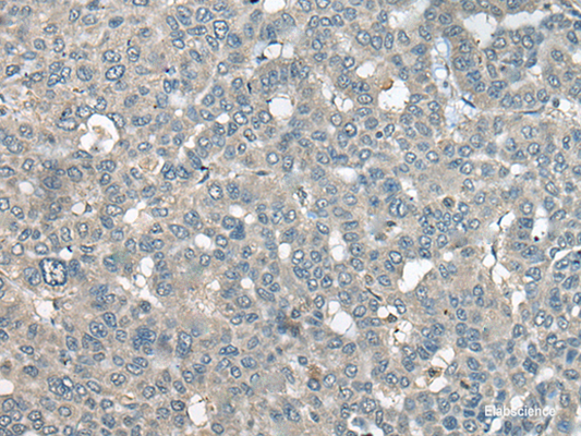 Immunohistochemistry of paraffin-embedded Human liver cancer tissue  using UCN3 Polyclonal Antibody at dilution of 1:55(×200)