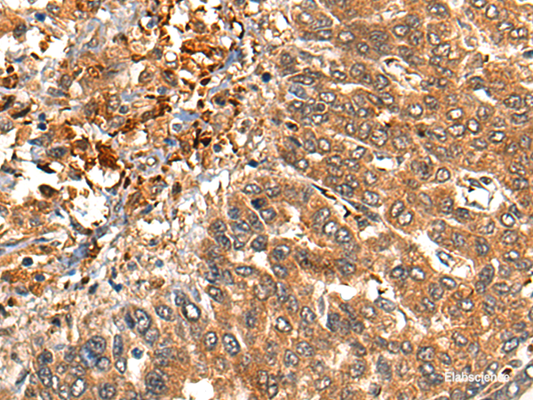 Immunohistochemistry of paraffin-embedded Human liver cancer tissue  using MARK3 Polyclonal Antibody at dilution of 1:40(×200)