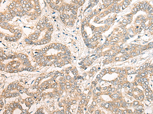 Immunohistochemistry of paraffin-embedded Human liver cancer tissue  using PCDHGB5 Polyclonal Antibody at dilution of 1:40(×200)