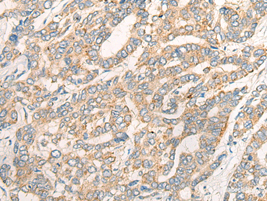 Immunohistochemistry of paraffin-embedded Human liver cancer tissue  using CCL16 Polyclonal Antibody at dilution of 1:45(×200)