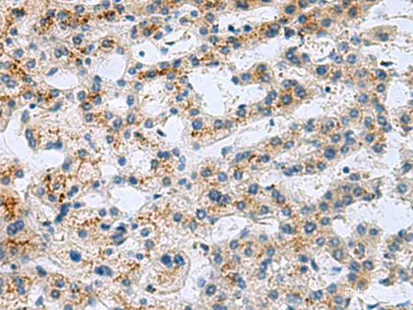 Immunohistochemistry of paraffin-embedded Human liver cancer tissue  using GHRHR Polyclonal Antibody at dilution of 1:40(×200)