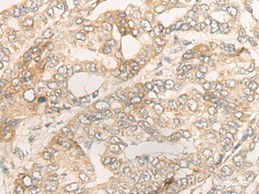 Immunohistochemistry of paraffin-embedded Human liver cancer tissue  using DUOX2 Polyclonal Antibody at dilution of 1:40(×200)
