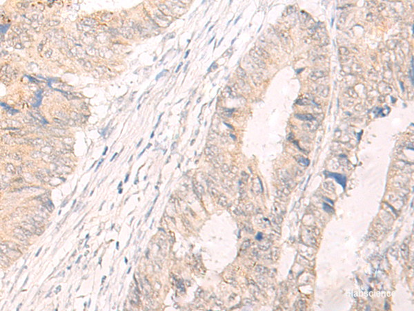 Immunohistochemistry of paraffin-embedded Human colorectal cancer tissue  using IL33 Polyclonal Antibody at dilution of 1:25(×200)