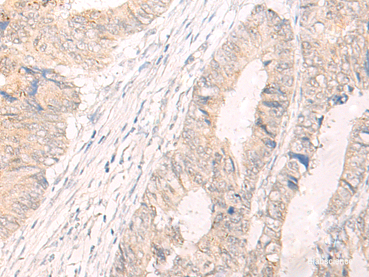 Immunohistochemistry of paraffin-embedded Human colorectal cancer tissue  using IL33 Polyclonal Antibody at dilution of 1:25(×200)