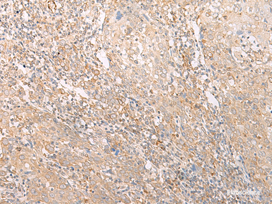 Immunohistochemistry of paraffin-embedded Human cervical cancer tissue  using EPS15 Polyclonal Antibody at dilution of 1:50(×200)