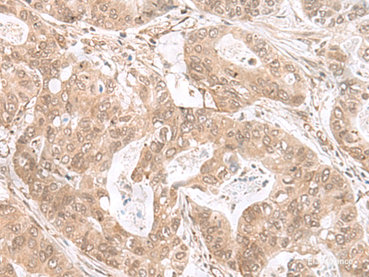Immunohistochemistry of paraffin-embedded Human gastric cancer tissue  using ETV3 Polyclonal Antibody at dilution of 1:25(×200)