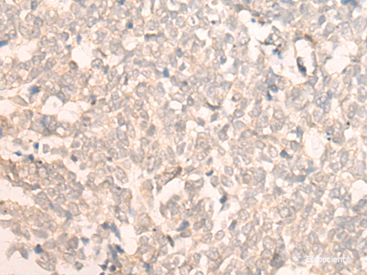 Immunohistochemistry of paraffin-embedded Human lung cancer tissue  using FAN1 Polyclonal Antibody at dilution of 1:30(×200)